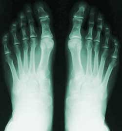 x-ray feet