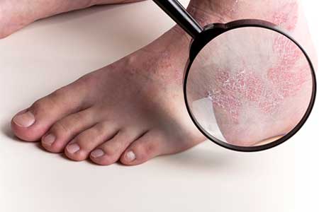 foot with skin rash