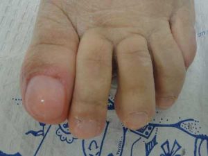 After - toe nails with treatment applied