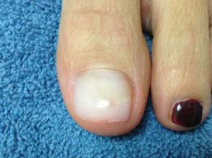 After - big toe nail with KeryFlex applied