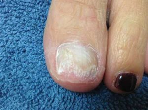 Before - broken, chipped big toe nail