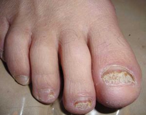 Before - big toe with discolored nail